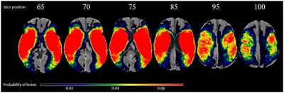 The Impact of Covariates in Voxel-Wise Lesion-Symptom Mapping